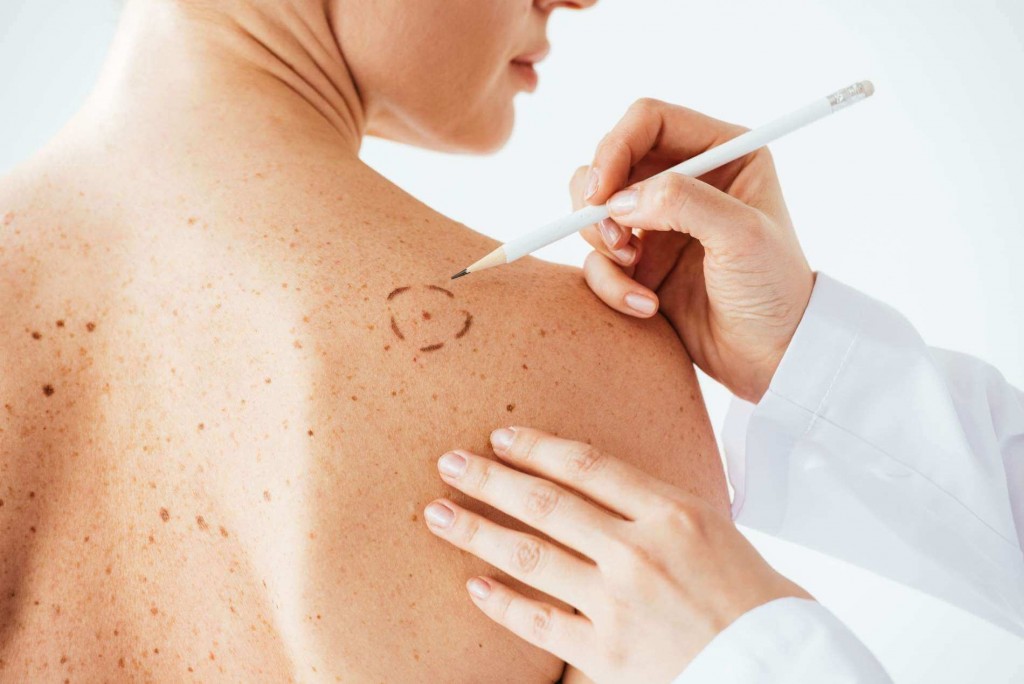 Día Mundial del Melanoma: La clave es prevenir y concientizar