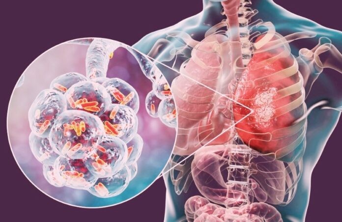 Tuberculosis: entre 2020 y  2025 los casos aumentaron un 65%